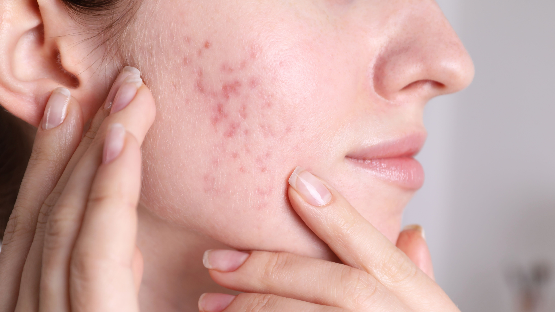 Acne en littekenbehandeling