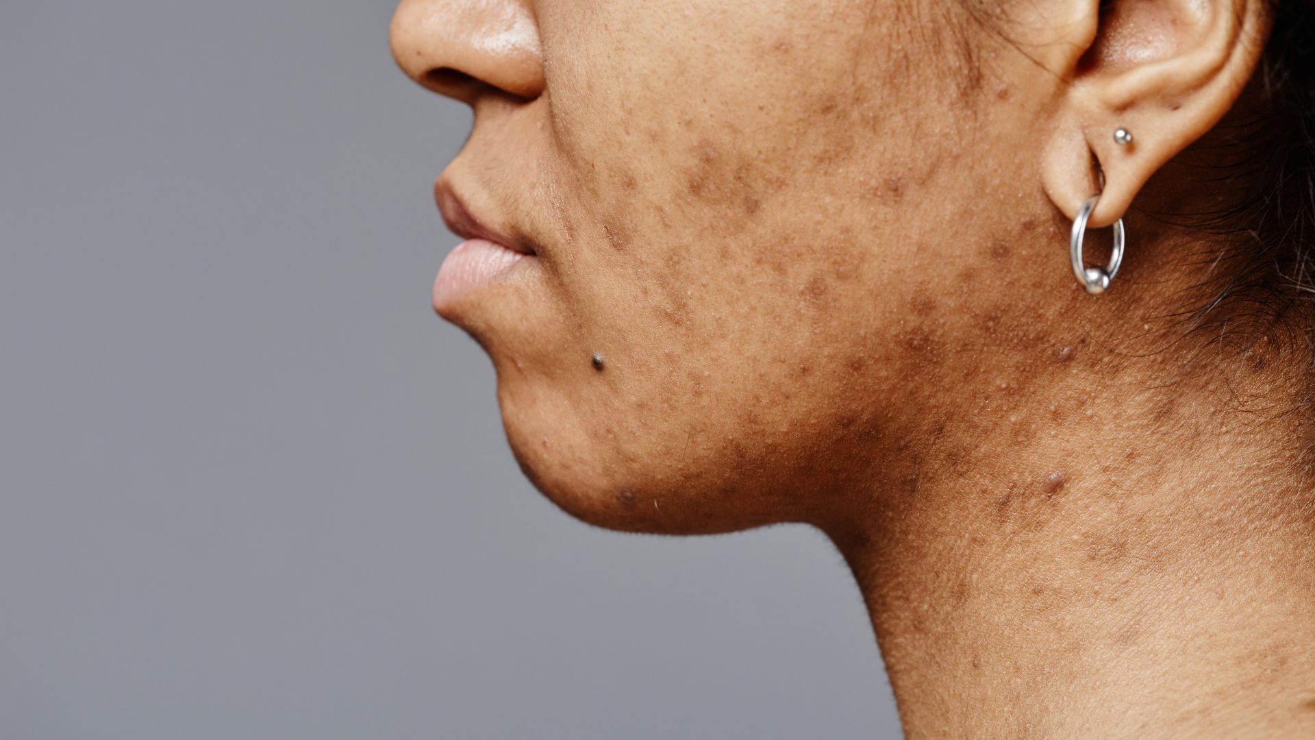 Pigmentbehandeling - IPL Ellipse Nordlys