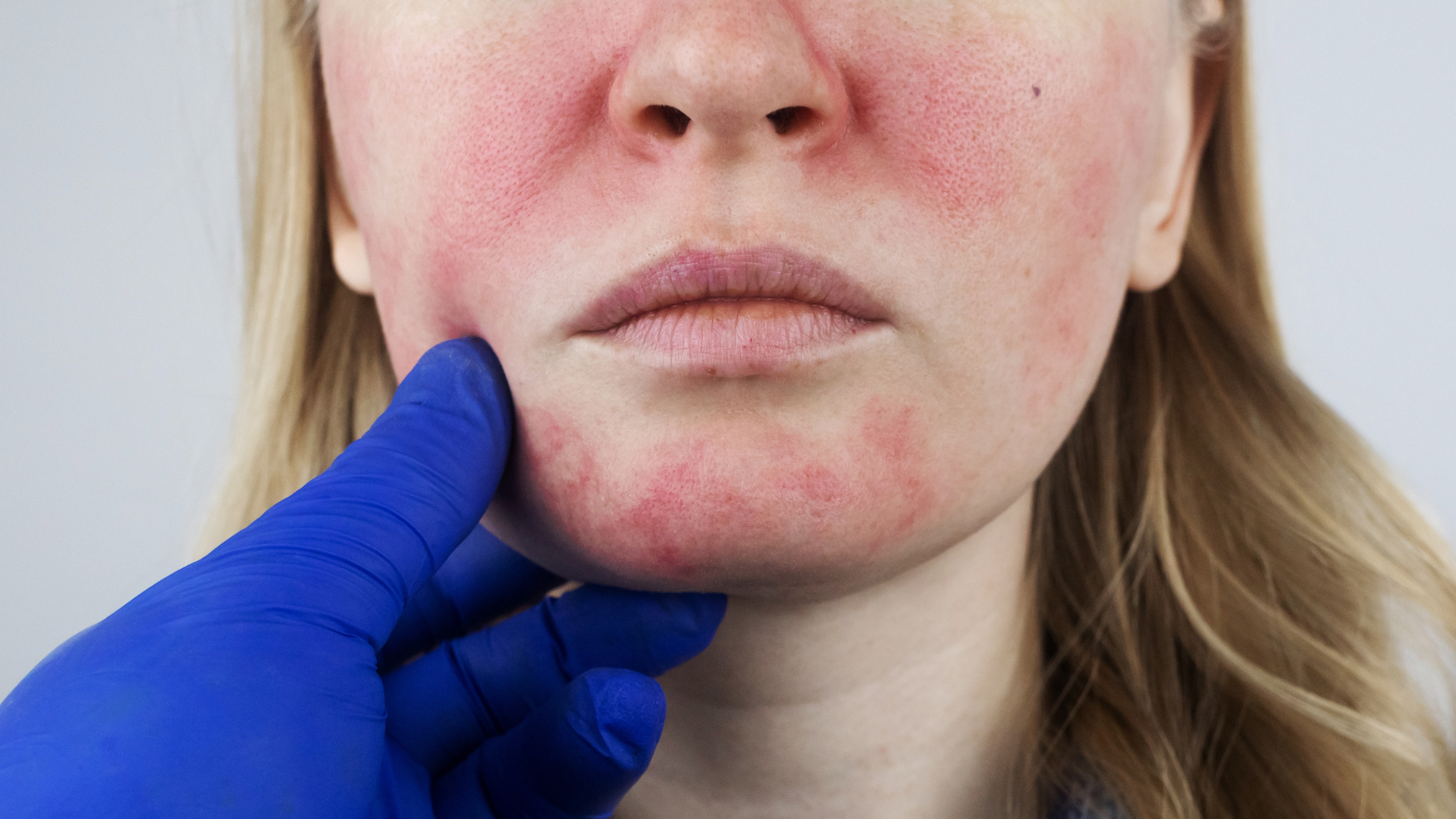 Vaatbehandeling - IPL Ellipse Nordlys