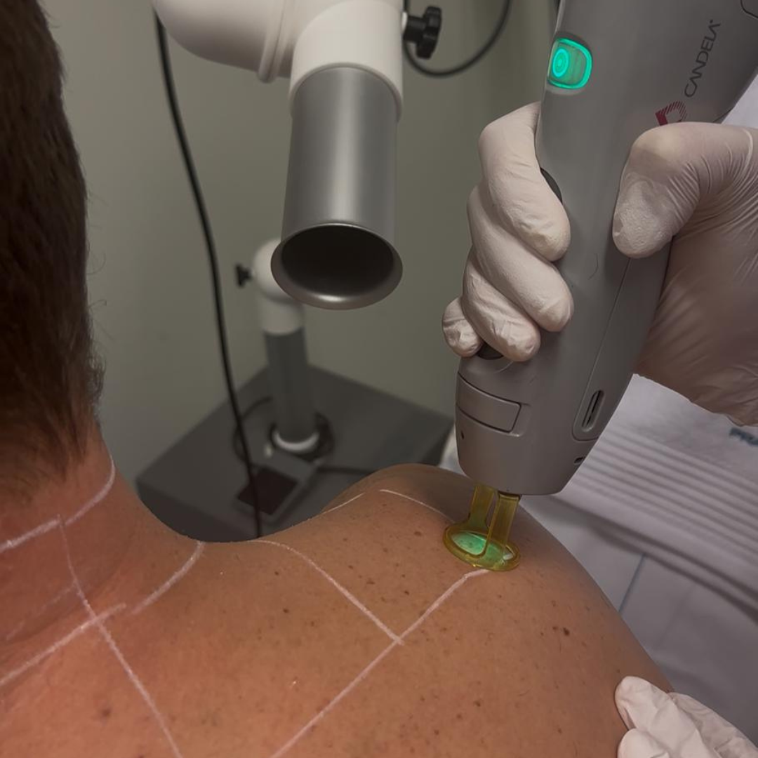 Laser ontharen in Winschoten