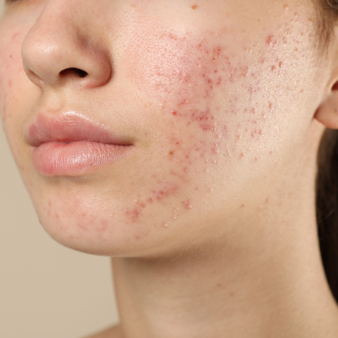 Acne behandeling in Drachten